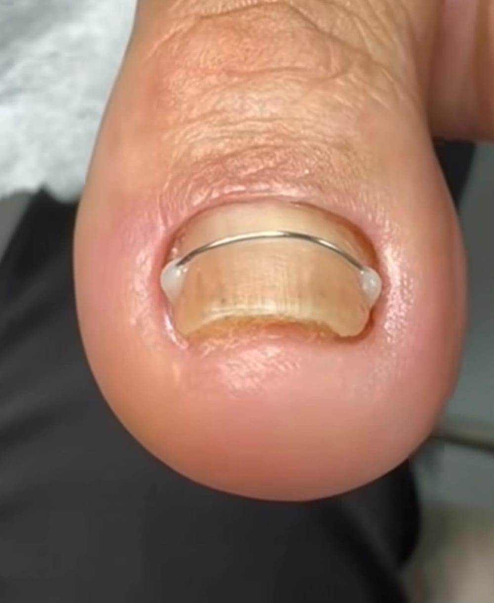 Wire brace on a big toenail