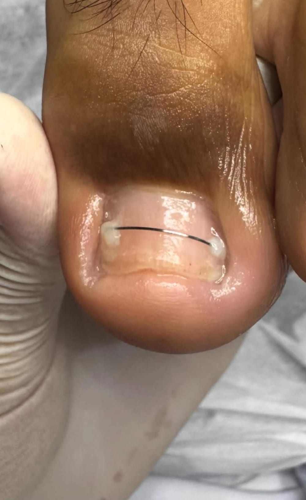 Fine corrective brace after fitting